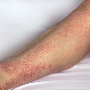 Systemic-Vasculitis