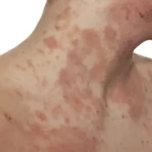 atopische-dermatitis-neurodermitis-behandlung-hautarzt-wien-dr-okamoto