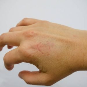 A bite mark on a hand